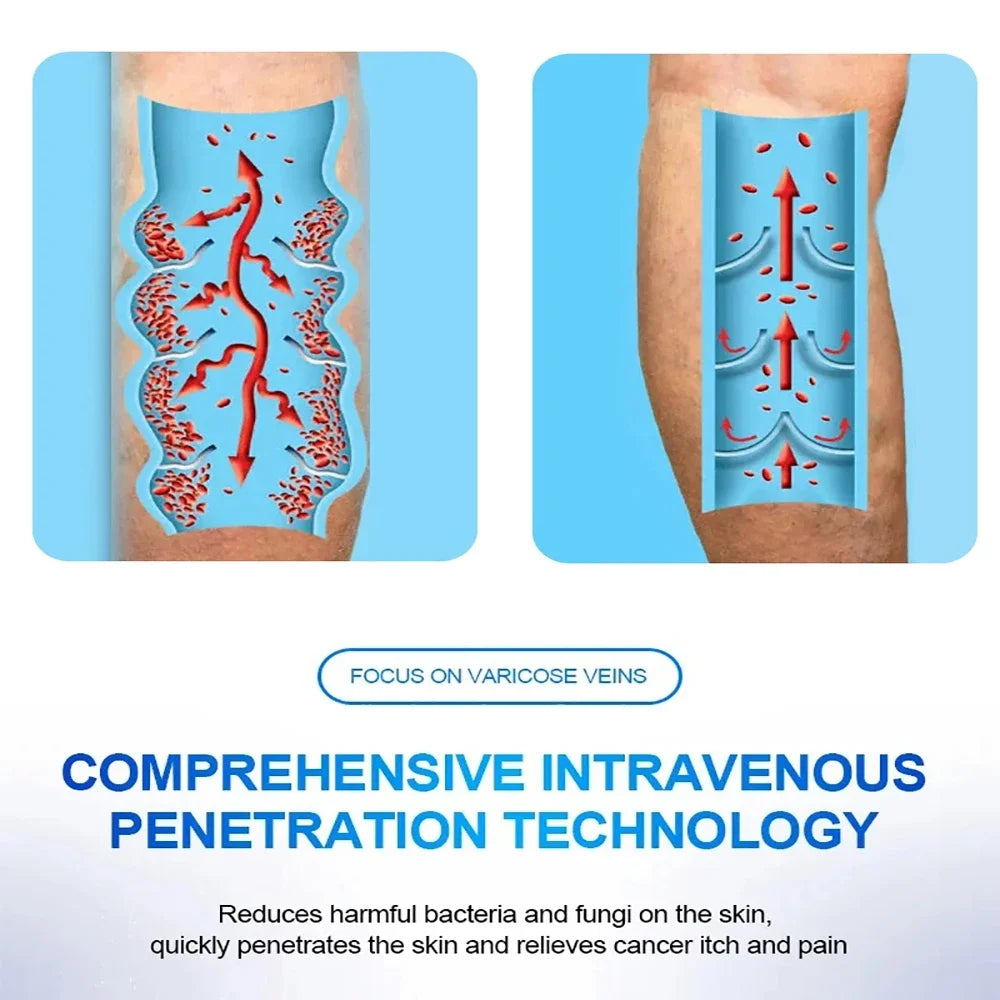 Varicose Vein Lampshade Therapy Effective Improved Blood Circulation Relief Of Dilated Vasculitis In The Legs Phlebitis