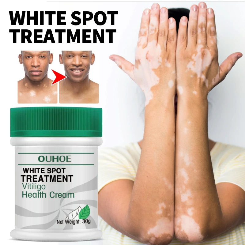 30g White Spot Treatment Disease Cream Ointment Leukoplakia Repair Vitiligo Pigment Melanin Skin Care Beauty Health Maquiagem