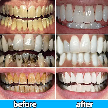 Remover Dental Calculus Toothpaste Preventing Periodontitis Whitening Teeth Efficient Mouth Odour Removal Bad Breath Fresh Oral